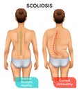 Normal healthy spine and curved spine with scoliosis